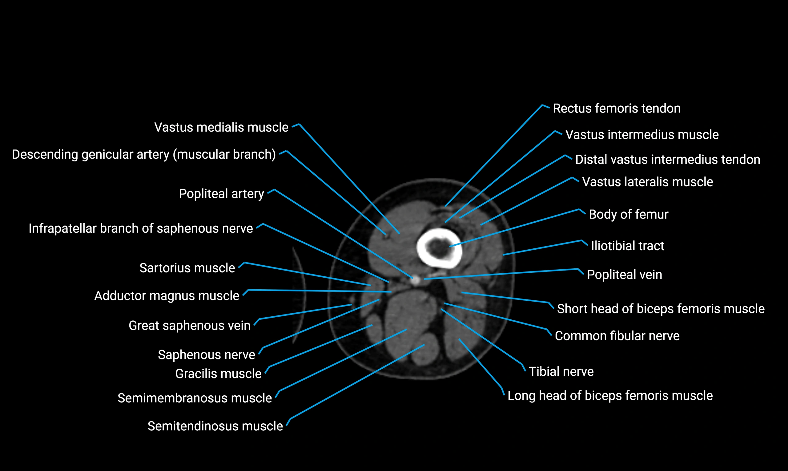 CT thigh axial cross sectional anatomy labelled image_66 (2).webp